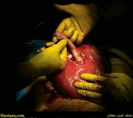 تصاویر: جنین نارسی که در شکم مادر انگشت دکتر را گرفت!