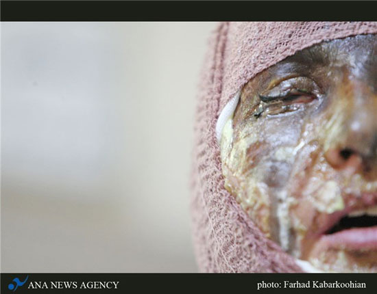 www.dustaan.com-اسید پاشی زیبایی «سیما» را تباه کرد3