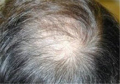 dustaan.com-گیاهی برای جلوگیری از ریزش مو