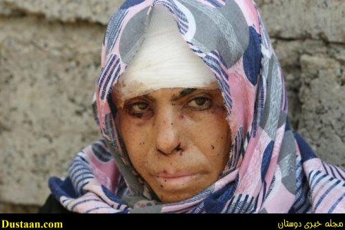 An injured displaced woman from Qayyara poses for a picture in Qayyara, Iraq, August 29, 2016. REUTERS/Azad Lashkari