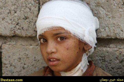 An injured displaced girl from Qayyara poses for a picture in Qayyara, Iraq, August 29, 2016. REUTERS/Azad Lashkari