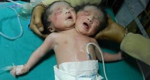 تولد پسر 2 سر در هند (+عکس)