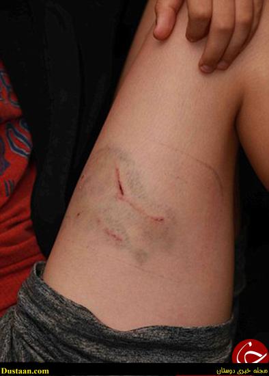 حمله سگ به کودک 9 ساله +تصاویر حمله سگ به کودک 9 ساله +تصاویر