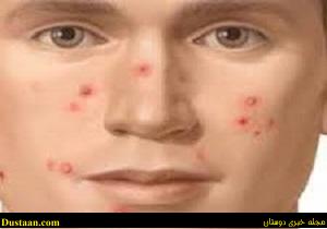 www.dustaan.com-درمان های خانگی برای از بین بردن کامل جوش صورت