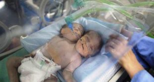 عکس نوزاد 2 سر در بیمارستان