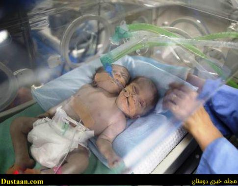 عکس نوزاد 2 سر در بیمارستان