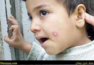 www.dustaan.com-جای ان زخم ها تا یک سال بر روی بدن می ماند!