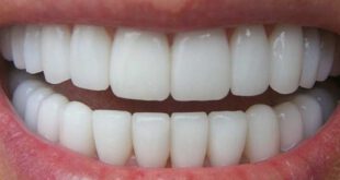 با این روش درمانی به دندان های خود زیبایی ببخشید