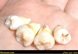 www.dustaan.com-بهترین زمان برای جراحی دندان عقل