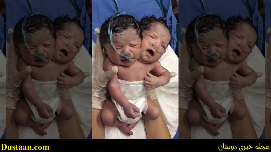 عکس عجیب از نوزاد ناقص الخلقه با دو سر