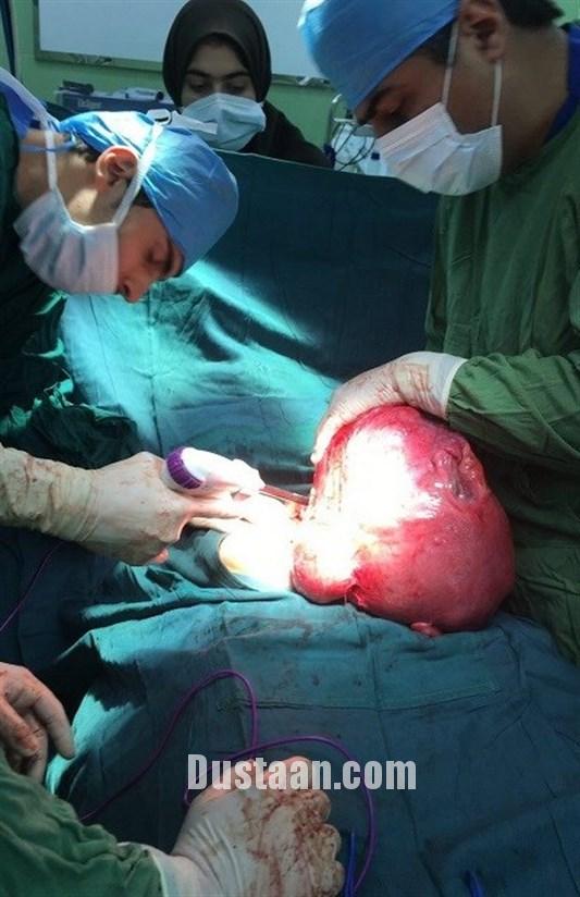 توده بزرگ در شکم بیمار توده بزرگ در شکم بیمار