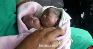 تولد یک نوزاد دوسر در سوریه