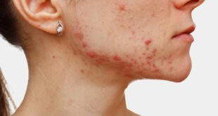 https://img.medscape.com/thumbnail_library/shs_160415_acne_face_cheek_800x600.jpg