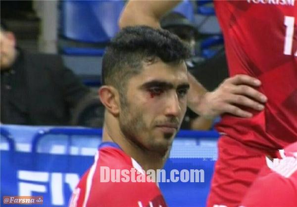 چشم میرزاجانپور دچار خون‌ریزی شد