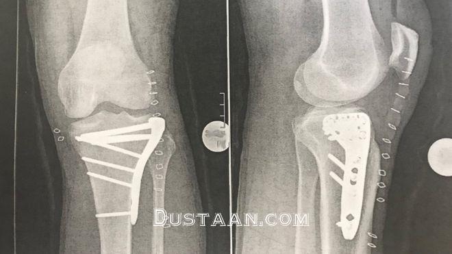 اولین تصویر مجری معروف پس از تصادف
