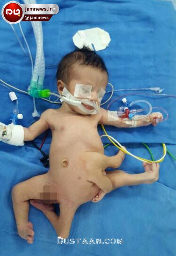 www.dustaan.com-تولد نوزادی عجیب الخلقه در عراق +تصاویر