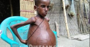 بیماری عجیب پسر ۷ ساله هندی