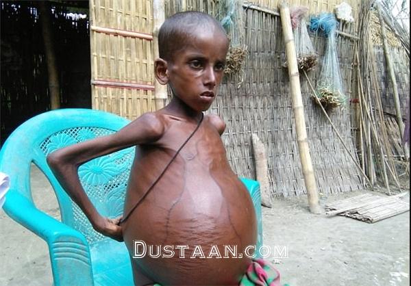 بیماری عجیب پسر ۷ ساله هندی