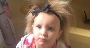 Unique: 21-month-old Phoebe Braswell has a rare condition called Uncombable Hair Syndrome'