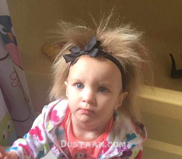Unique: 21-month-old Phoebe Braswell has a rare condition called Uncombable Hair Syndrome'