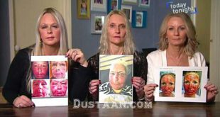 1-لیزر زیبایی چهره این زنان را نابود کرد+ تصاویر2-سوختگی درجه سه؛ نتیجه استفاده از لیزر زیبایی دراین زنان