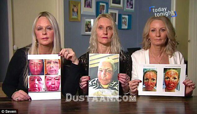 1-لیزر زیبایی چهره این زنان را نابود کرد+ تصاویر2-سوختگی درجه سه؛ نتیجه استفاده از لیزر زیبایی دراین زنان