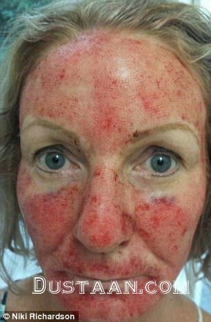 1-لیزر زیبایی چهره این زنان را نابود کرد+ تصاویر2-سوختگی درجه سه؛ نتیجه استفاده از لیزر زیبایی دراین زنان 1-لیزر زیبایی چهره این زنان را نابود کرد+ تصاویر2-سوختگی درجه سه؛ نتیجه استفاده از لیزر زیبایی دراین زنان