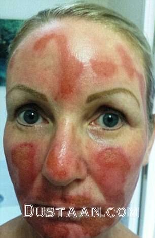 1-لیزر زیبایی چهره این زنان را نابود کرد+ تصاویر2-سوختگی درجه سه؛ نتیجه استفاده از لیزر زیبایی دراین زنان 1-لیزر زیبایی چهره این زنان را نابود کرد+ تصاویر2-سوختگی درجه سه؛ نتیجه استفاده از لیزر زیبایی دراین زنان