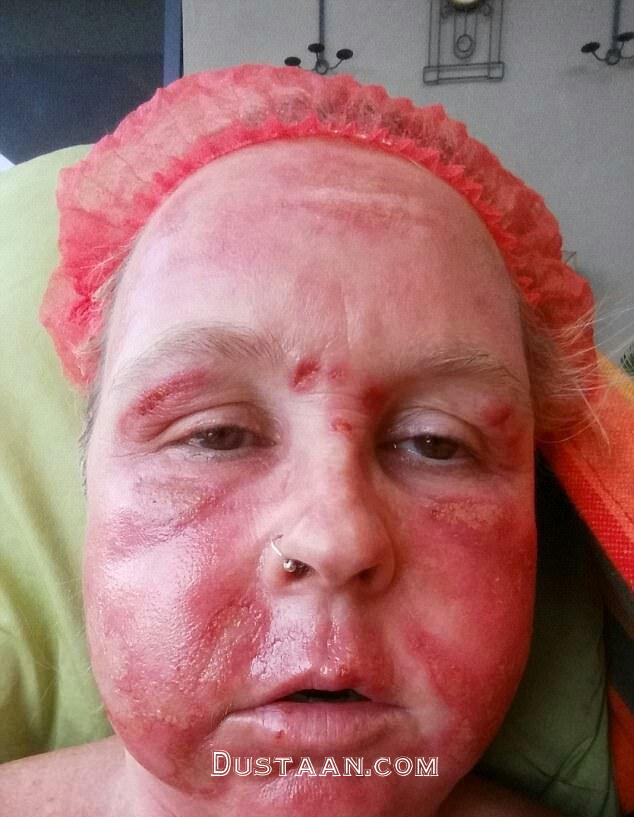 1-لیزر زیبایی چهره این زنان را نابود کرد+ تصاویر2-سوختگی درجه سه؛ نتیجه استفاده از لیزر زیبایی دراین زنان 1-لیزر زیبایی چهره این زنان را نابود کرد+ تصاویر2-سوختگی درجه سه؛ نتیجه استفاده از لیزر زیبایی دراین زنان