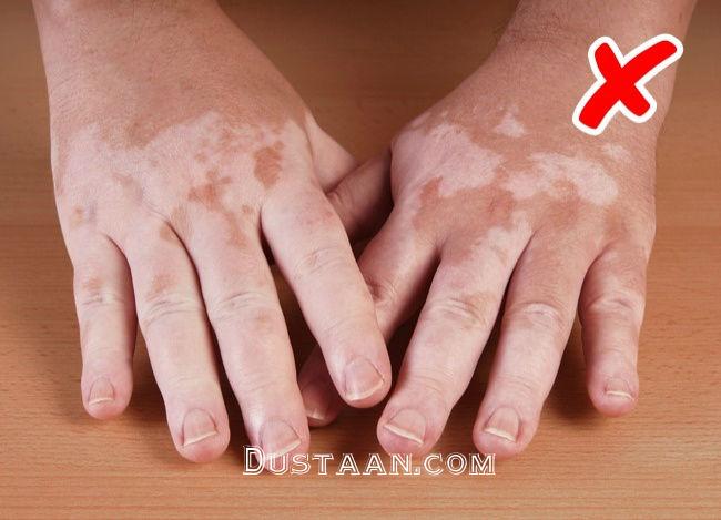 ۸ بیماری خطرناکی که نشانه های آن ها روی پوستتان ظاهر خواهد شد