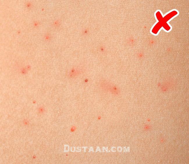 ۸ بیماری خطرناکی که نشانه های آن ها روی پوستتان ظاهر خواهد شد