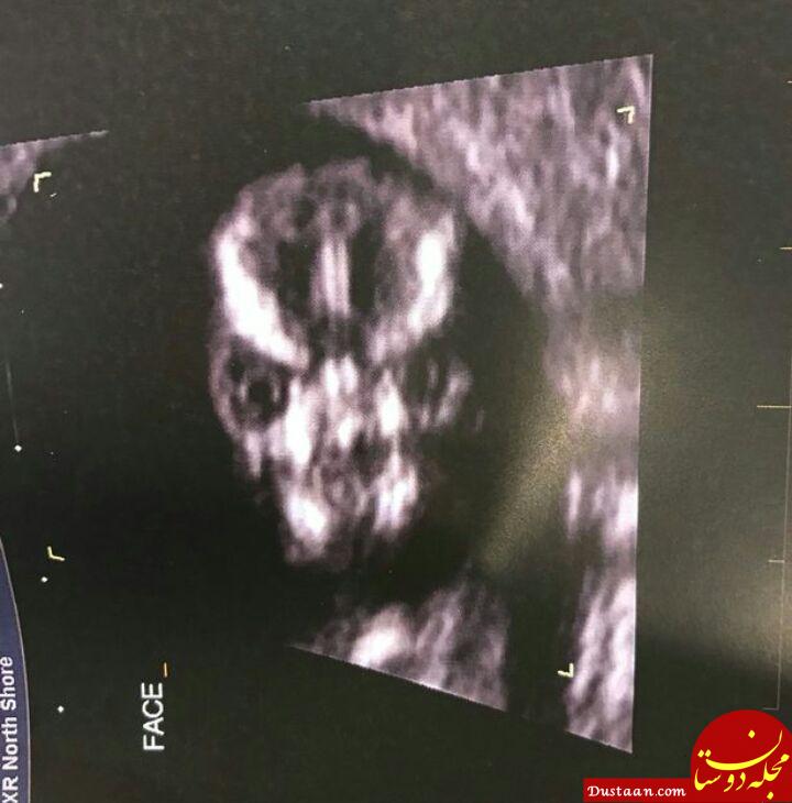 عکس عجیب جنین، موجب وحشت زن باردار جوان شد + تصاویر