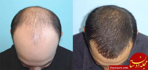 http://aestheticscosmeticcentre.com/files/uploads/2015/01/Hair-Transplant-Aestheticscosmeticcentre.jpg