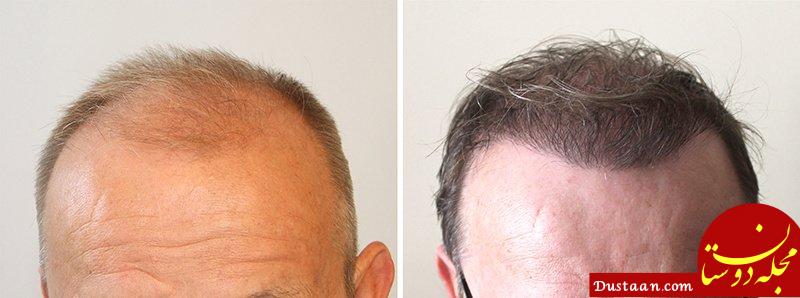 http://cdn.whatclinic.com/hair-loss/hungary/budapest/hairpalace-hair-transplant-clinic/thumbnails/5b17becf68043499/hair_restoration_hairpalace.jpg?hmac=66256074c0522e2d6349a29c0578bffff86775aa