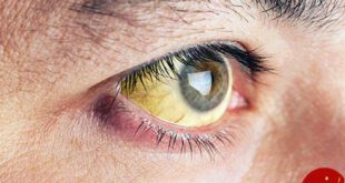 زرد شدن چشم تشخیص بیماری از روی چشم