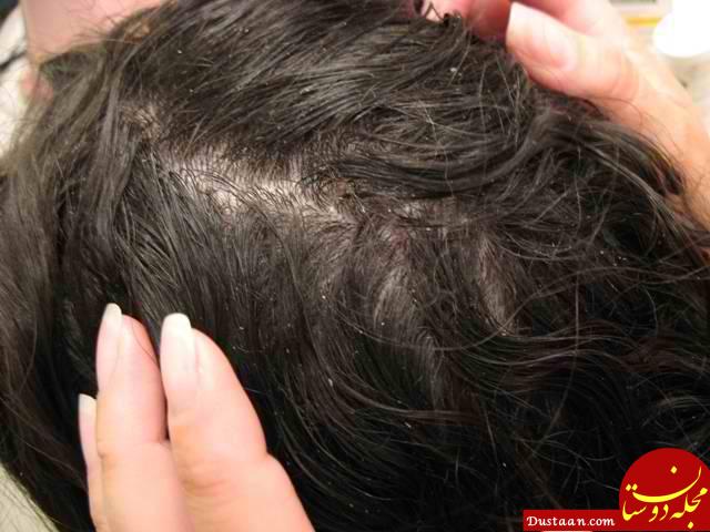 دلایل اصلی خارش سر چیست؟ + راه های درمان