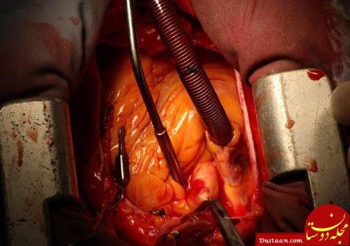 جراحی قلب با استفاده از دریچه‌های بدون نیاز به بخیه + تصاویر