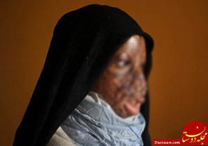 مرد سنگدل صورت همسرش را به علتی عجیب با اسید سوزاند+عکس