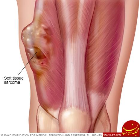 https://www.mayoclinic.org/-/media/kcms/gbs/patient-consumer/images/2013/08/26/10/20/ds00601_im04139_mcdc7_soft_tissue_sarcomathu_jpg.ashx