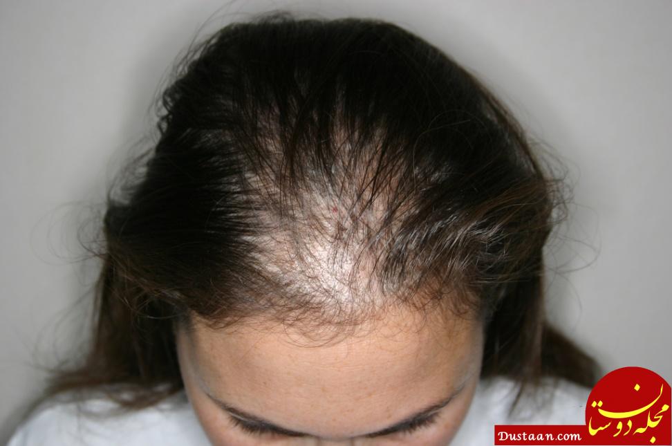 http://harcourthealth.com/wp-content/uploads/2016/11/Temporary-Hair-Loss.jpg