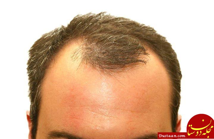 https://homeopathyplus.com/wp-content/uploads/2015/09/Hair_loss.jpg