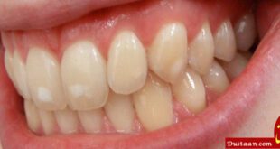 https://yousefabaddental.ir/wp-content/uploads/2017/06/white-spots-on-teeth-1024x768-1024x423.jpg