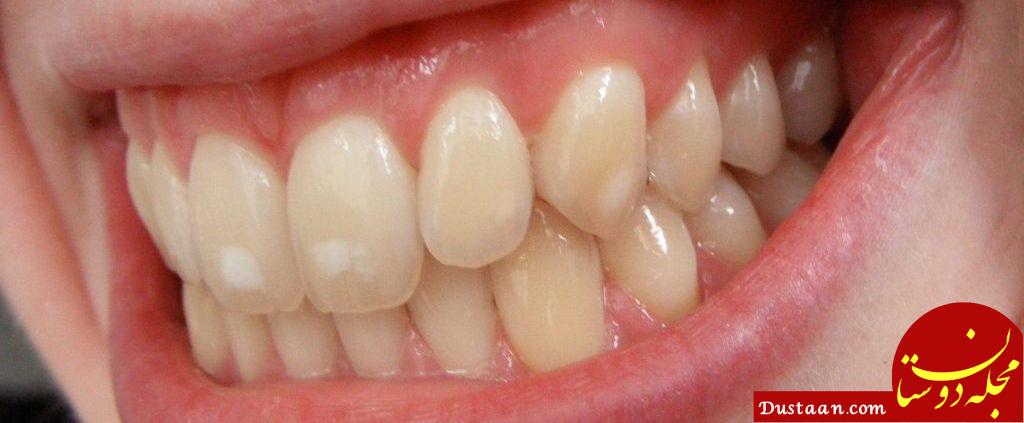 http://yousefabaddental.ir/wp-content/uploads/2017/06/white-spots-on-teeth-1024x768-1024x423.jpg
