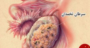 سرطان تخمدان,علائم سرطان تخمدان,علایم سرطان تخمدان