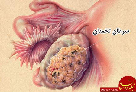 سرطان تخمدان,علائم سرطان تخمدان,علایم سرطان تخمدان