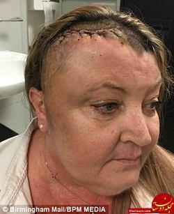 خارج شدن تومور عجیب از سر این زن پس از دوسال!+عکس