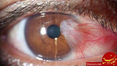 بیماری ناخنک چشم, علل ایجاد ناخنک چشم