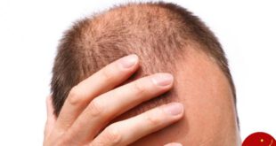 https://cdn1.medicalnewstoday.com/content/images/articles/315/315859/man-balding.jpg