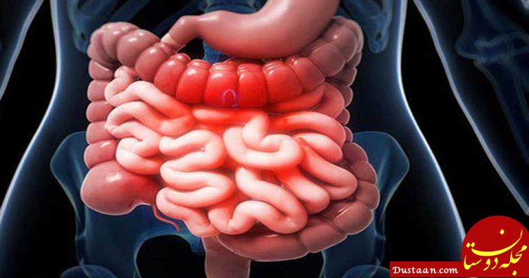 https://salamati.ir/wp-content/uploads/2017/05/Crohn-disease-760x400.jpg