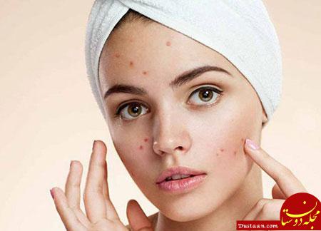 https://www.beytoote.com/images/stories/health/acne-01.jpg